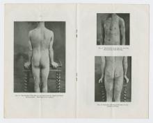 Three figures of a nude male's front and backside displaying blistering and discolouration.